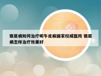 银屑病如何治疗呢牛皮癣国家权威医院 银屑病怎样治疗效果好