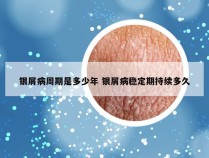 银屑病周期是多少年 银屑病稳定期持续多久