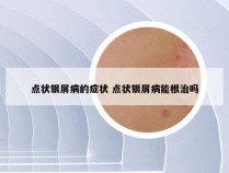 点状银屑病的症状 点状银屑病能根治吗