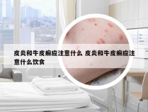 皮炎和牛皮癣应注意什么 皮炎和牛皮癣应注意什么饮食