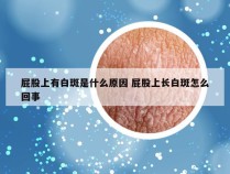 屁股上有白斑是什么原因 屁股上长白斑怎么回事