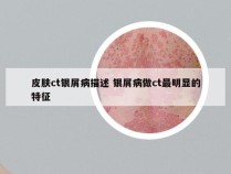 皮肤ct银屑病描述 银屑病做ct最明显的特征