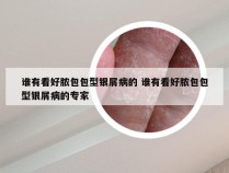 谁有看好脓包包型银屑病的 谁有看好脓包包型银屑病的专家