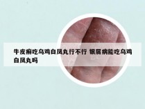 牛皮癣吃乌鸡白凤丸行不行 银屑病能吃乌鸡白凤丸吗