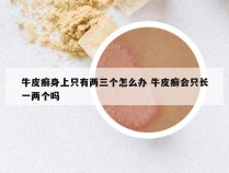 牛皮癣身上只有两三个怎么办 牛皮癣会只长一两个吗