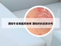 濮阳牛皮癣医院微博 濮阳好的皮肤诊所
