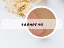 牛皮癣光疗的疗程
