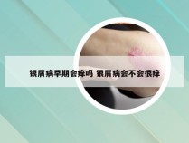 银屑病早期会痒吗 银屑病会不会很痒