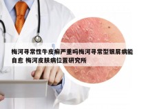 梅河寻常性牛皮癣严重吗梅河寻常型银屑病能自愈 梅河皮肤病位置研究所