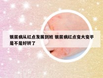 银屑病从红点发展到班 银屑病红点变大变平是不是好转了