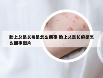 脸上总是长癣是怎么回事 脸上总是长癣是怎么回事图片