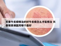长春牛皮癣哪治的好牛皮癣怎么才能根治 长春银屑病医院哪个最好