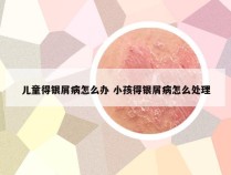儿童得银屑病怎么办 小孩得银屑病怎么处理