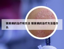 银屑病的治疗和方法 银屑病的治疗方法是什么
