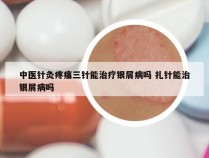 中医针灸疼痛三针能治疗银屑病吗 扎针能治银屑病吗