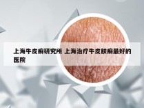 上海牛皮癣研究所 上海治疗牛皮肤癣最好的医院