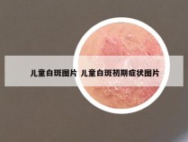儿童白斑图片 儿童白斑初期症状图片