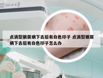 点滴型银屑病下去后有白色印子 点滴型银屑病下去后有白色印子怎么办