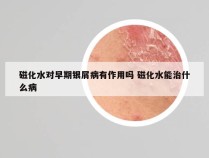磁化水对早期银屑病有作用吗 磁化水能治什么病