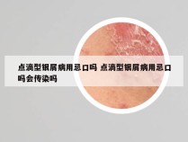 点滴型银屑病用忌口吗 点滴型银屑病用忌口吗会传染吗