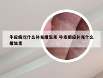 牛皮癣吃什么补充维生素 牛皮癣应补充什么维生素