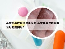 寻常型牛皮癣可以不治疗 寻常性牛皮肤癣有治好的案例吗?