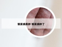银屑病黑肿 银屑病肿了