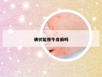 碘伏能擦牛皮癣吗