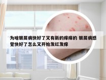 为啥银屑病快好了又有新的痒痒的 银屑病感觉快好了怎么又开始发红发痒