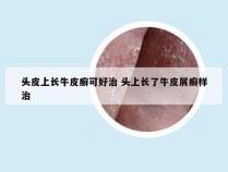 头皮上长牛皮癣可好治 头上长了牛皮屑癣样治
