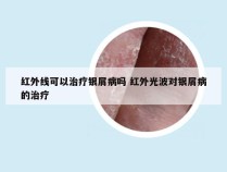红外线可以治疗银屑病吗 红外光波对银屑病的治疗