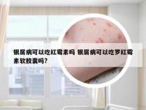 银屑病可以吃红霉素吗 银屑病可以吃罗红霉素软胶囊吗?