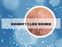 银屑病脚肿了什么原因 银屑病脚部