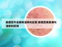 脓疱性牛皮癣和湿疹的区别 脓疱型银屑病与湿疹的区别