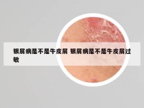 银屑病是不是牛皮屑 银屑病是不是牛皮屑过敏