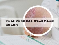 艾滋会引起头皮银屑病么 艾滋会引起头皮银屑病么图片