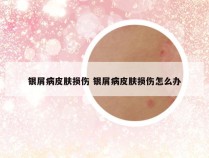 银屑病皮肤损伤 银屑病皮肤损伤怎么办