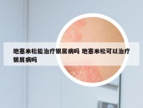 地塞米松能治疗银屑病吗 地塞米松可以治疗银屑病吗