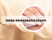银屑病或 银屑病或者脂溢性皮炎能治好吗