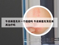 牛皮癣是先长一个痘痘吗 牛皮癣是先发出来再治疗吗
