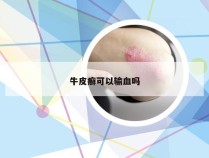 牛皮癣可以输血吗
