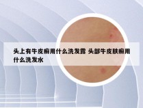 头上有牛皮癣用什么洗发露 头部牛皮肤癣用什么洗发水