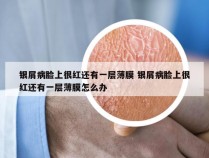 银屑病脸上很红还有一层薄膜 银屑病脸上很红还有一层薄膜怎么办