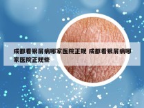 成都看银屑病哪家医院正规 成都看银屑病哪家医院正规些