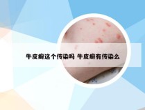 牛皮癣这个传染吗 牛皮癣有传染么