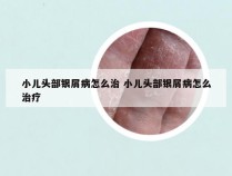 小儿头部银屑病怎么治 小儿头部银屑病怎么治疗