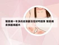 银屑病一年多的皮损都没见好咋回事 银屑病皮损越来越大