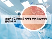 银屑病北京哪里治疗效果好 银屑病北京哪个医院治得好