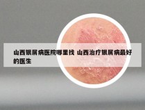 山西银屑病医院哪里找 山西治疗银屑病最好的医生