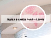 便宜好用牛皮癣药膏 牛皮癣什么牌子好